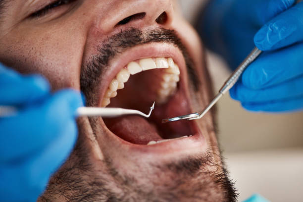 Teeth Whitening in OH
